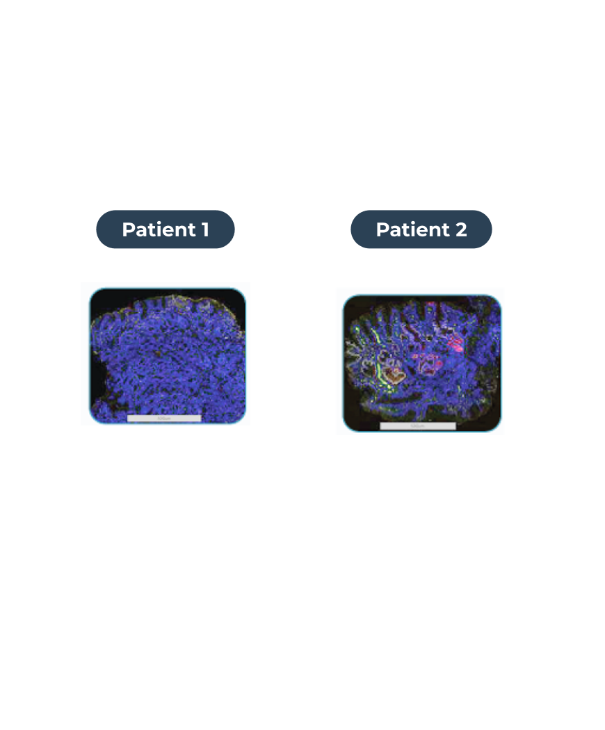 The two patient's esophageal tissue biopsies have different protein expression and and spatial biology 