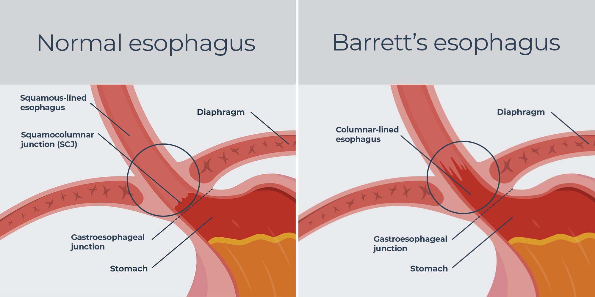 "Barretts esophagus","esophageal cancer","barrett's esophagus hiatal hernia